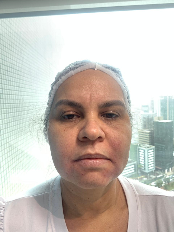 Depois - Preenchimento de Bigode Chinês