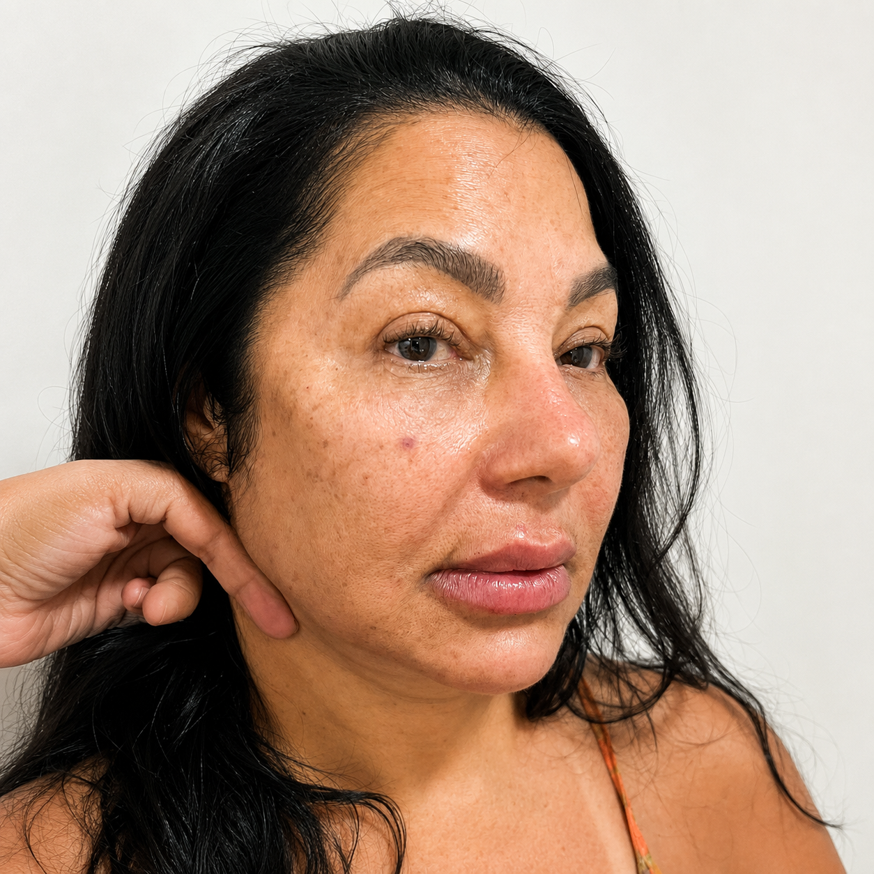 Depois - Harmonização Facial
