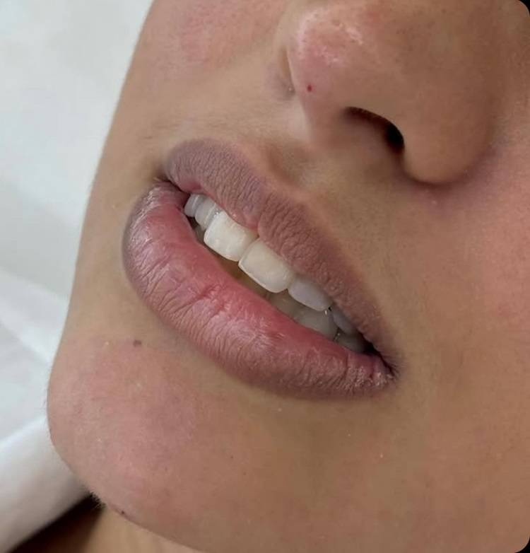 Antes - Preenchimento Labial